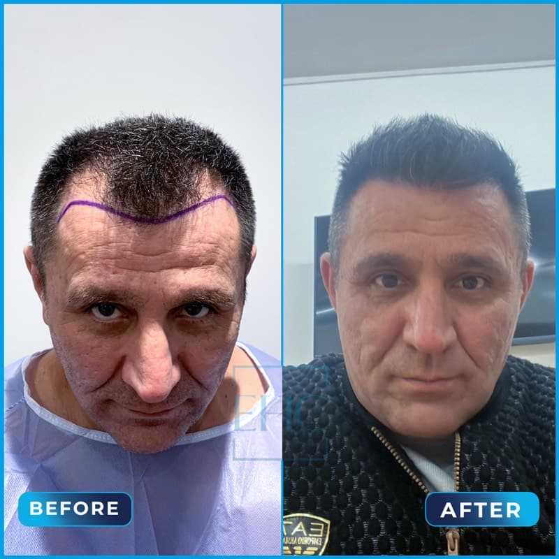 Cengiz Gürbüz - Before and After hair transplant