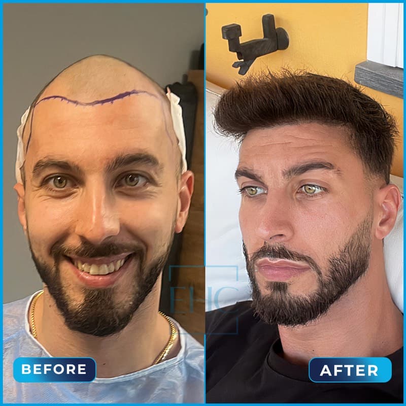 Daniel Busaccar - Before and After hair transplant