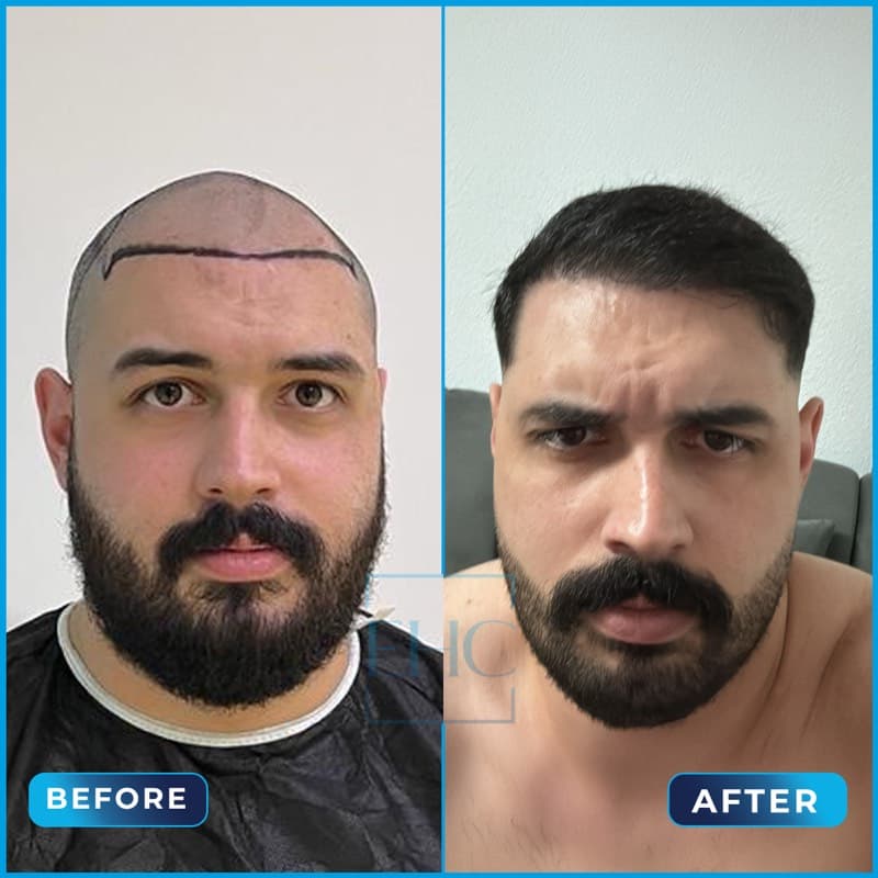 Ismail Kara - Before and After hair transplant