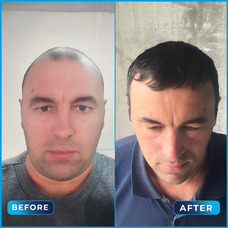 Iulian - Before and After hair transplant