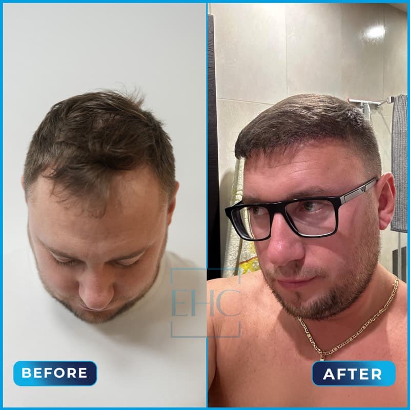Maurisuz - Before and After hair transplant
