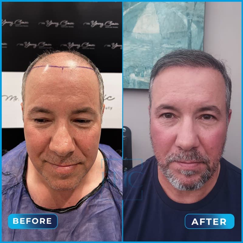 Michael Monti - Before and After hair transplant