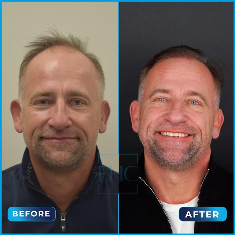 Mirek - Hair transplant before and after results